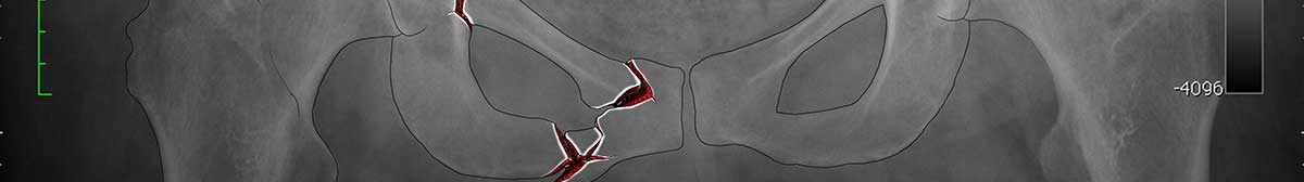 Highlight Mechanism of Injury